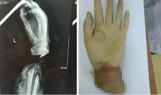 茱莉|太狠了！22岁姑娘把自己的手锯断，只为了……