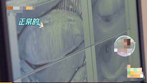 杨迪|知名艺人眼睛睑板腺消失！这个热搜注意了……