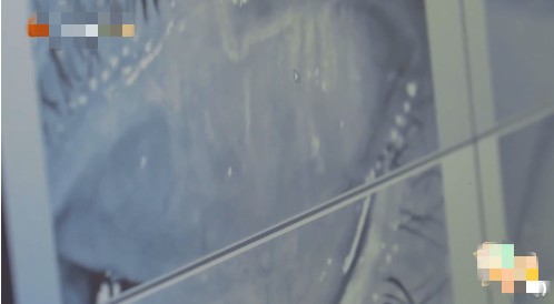 杨迪|知名艺人眼睛睑板腺消失！这个热搜注意了……