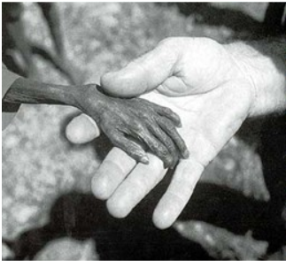 水俣病患者的惨状丨维基百科