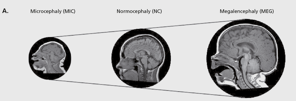 三种不同的脑尺寸MRI对比（图源：doi：10.31887/DCNS.2018.20.4/gmirzaa）