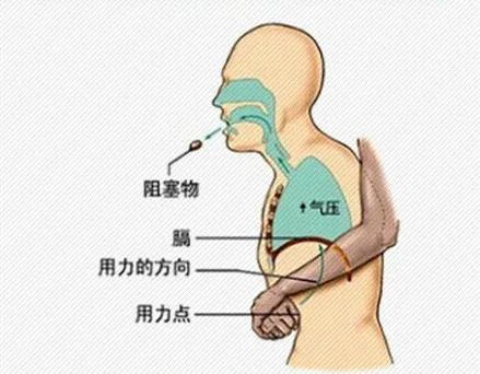 海姆立克急救法的原理:利用冲击腹部———膈肌下软组织,被突然的冲击