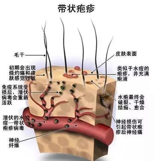 水痘的过程图片