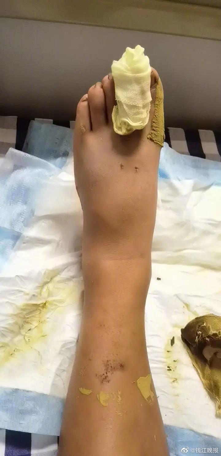 正当他走到桥头草丛时,左脚食指脚趾头猛地传来一阵刺痛,他低头一看