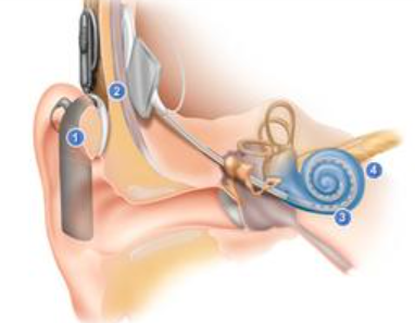 人工耳蜗|人工耳蜗植入需要开颅？人工耳蜗：不传谣不信谣