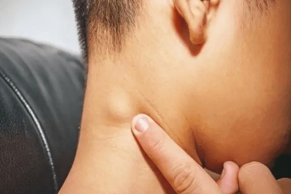 一个方子散结节身上的包块结节都散了