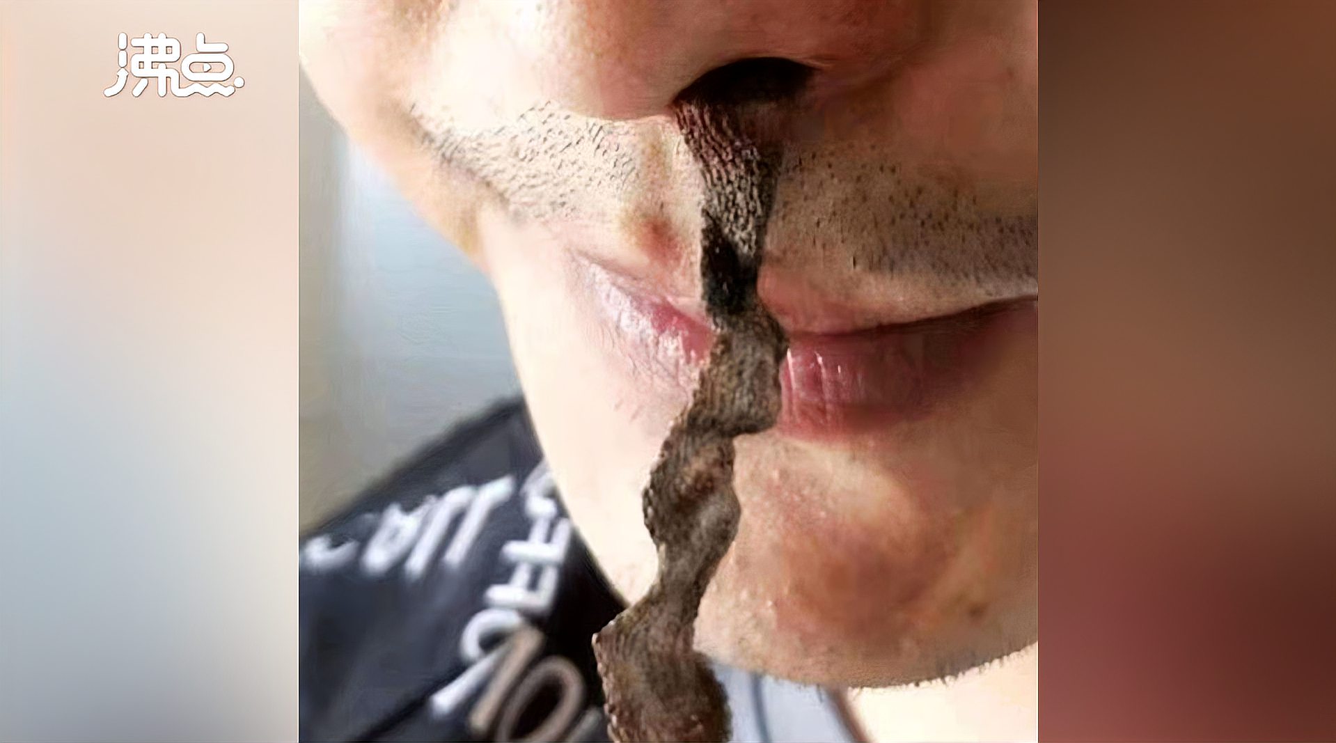 【 12厘米手术纱布遗留男子鼻内14年 :擤鼻涕时掉了出来 准备申请医疗