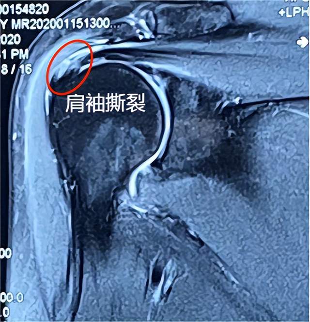 肩袖损伤症状图片