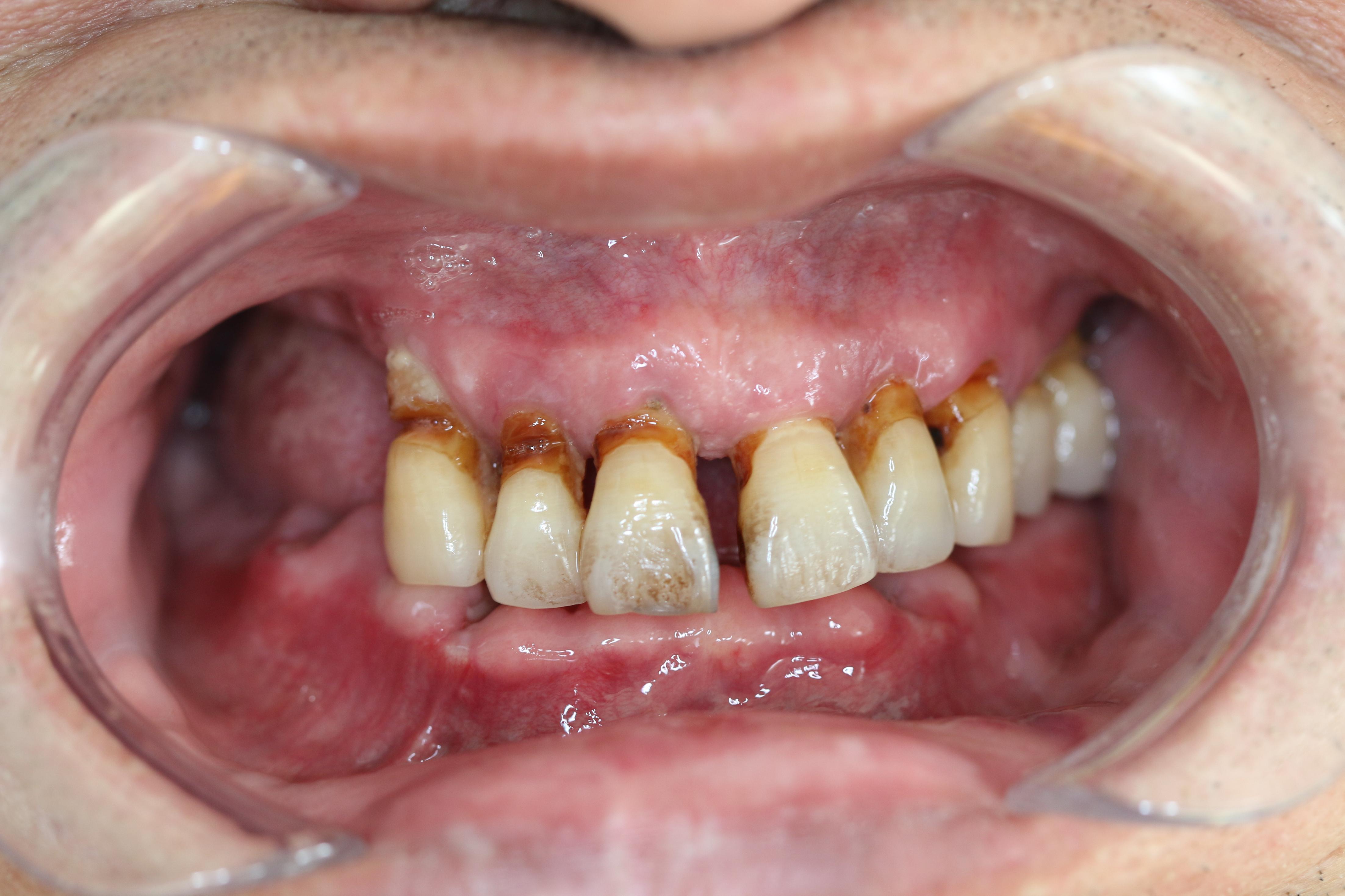 牙周炎患者长期食用槟榔