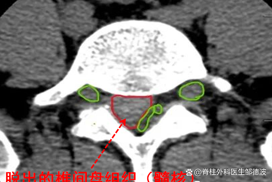 髓核脱至腰5椎体后方，压迫右侧神经