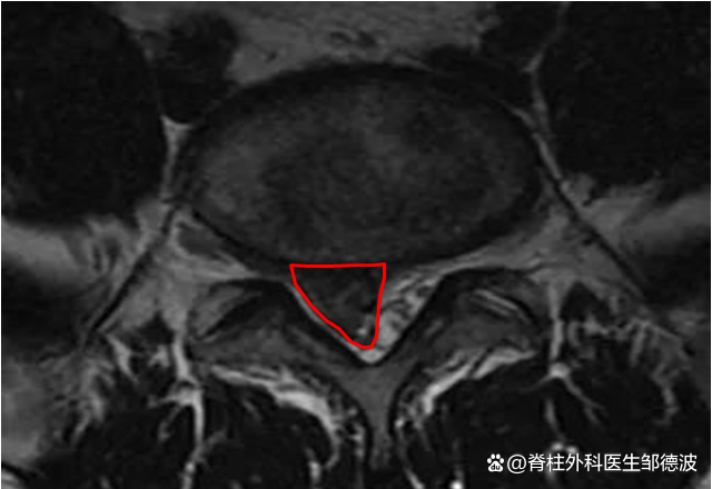髓核脱至腰5椎体后方，压迫右侧神经