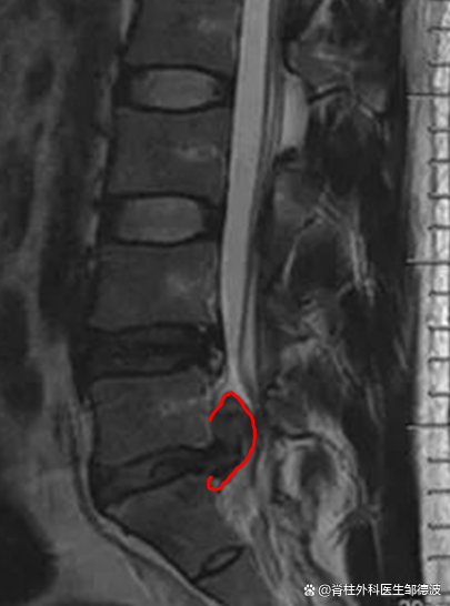腰5/骶1椎间盘脱出