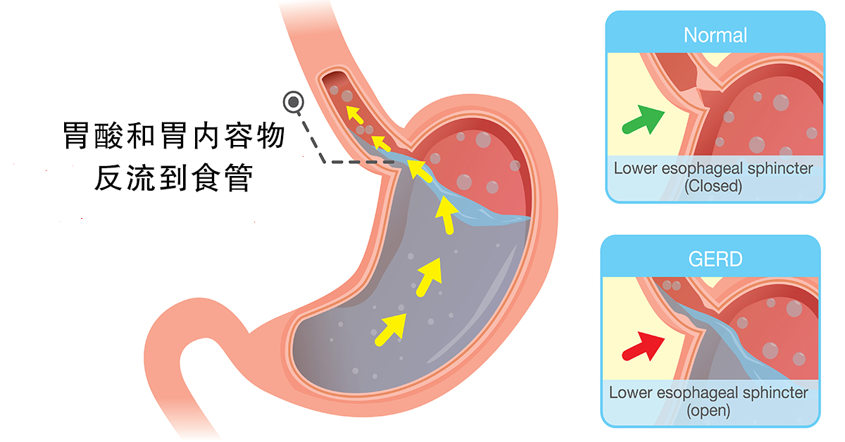 胃食管反流病：了解它，解决它