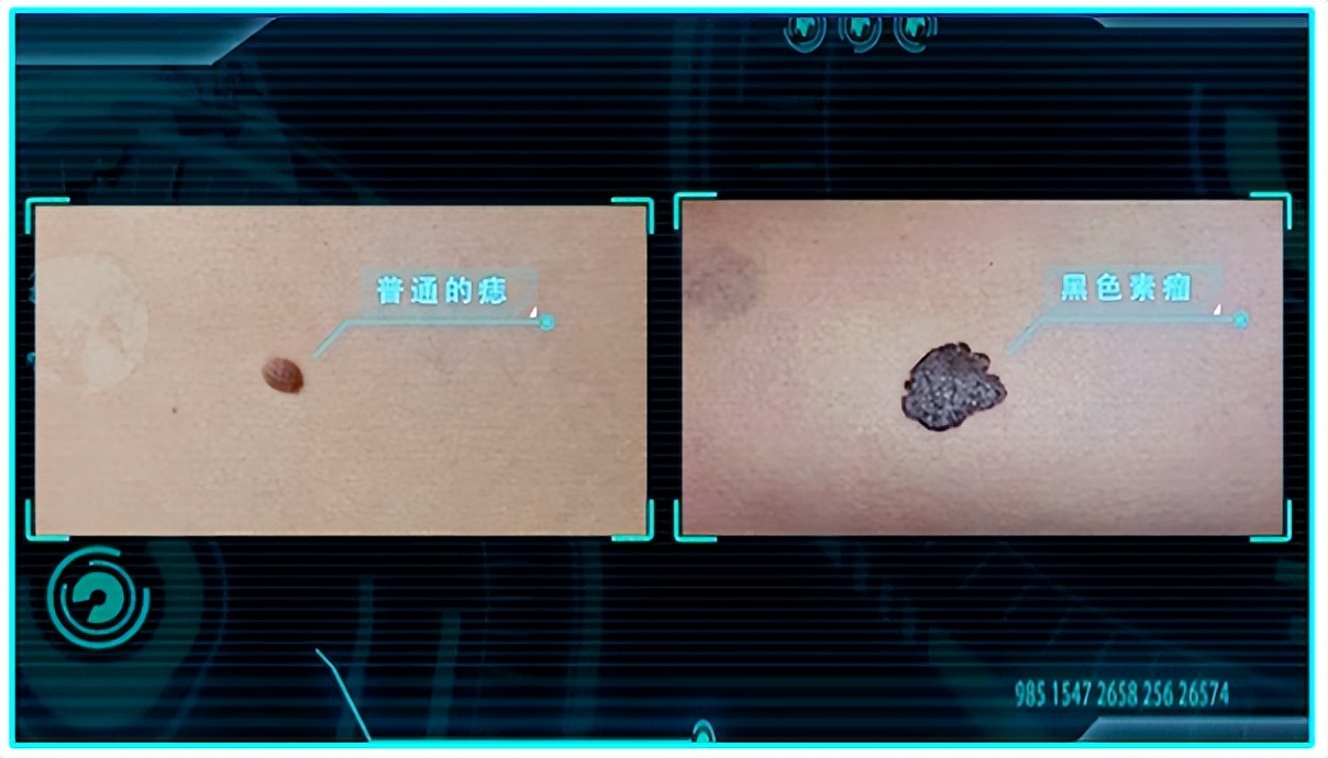 黑色素瘤边缘不整,有的出现锯齿状,有的痕迹像是被刀切过,而普通的痣